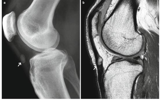 髕腱炎成為醫(yī)學(xué)焦點(diǎn)，從幕后走向舞臺(tái)中央的最新進(jìn)展