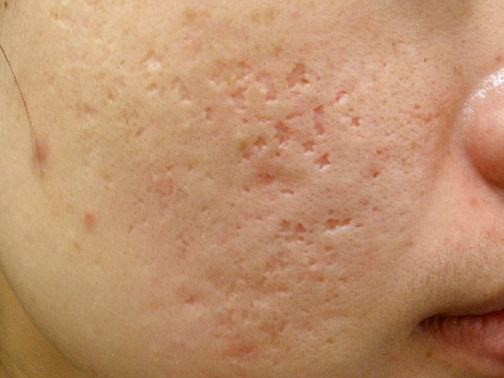 最新痘坑撫平神器，科技重塑肌膚之美，自信生活從此開(kāi)始