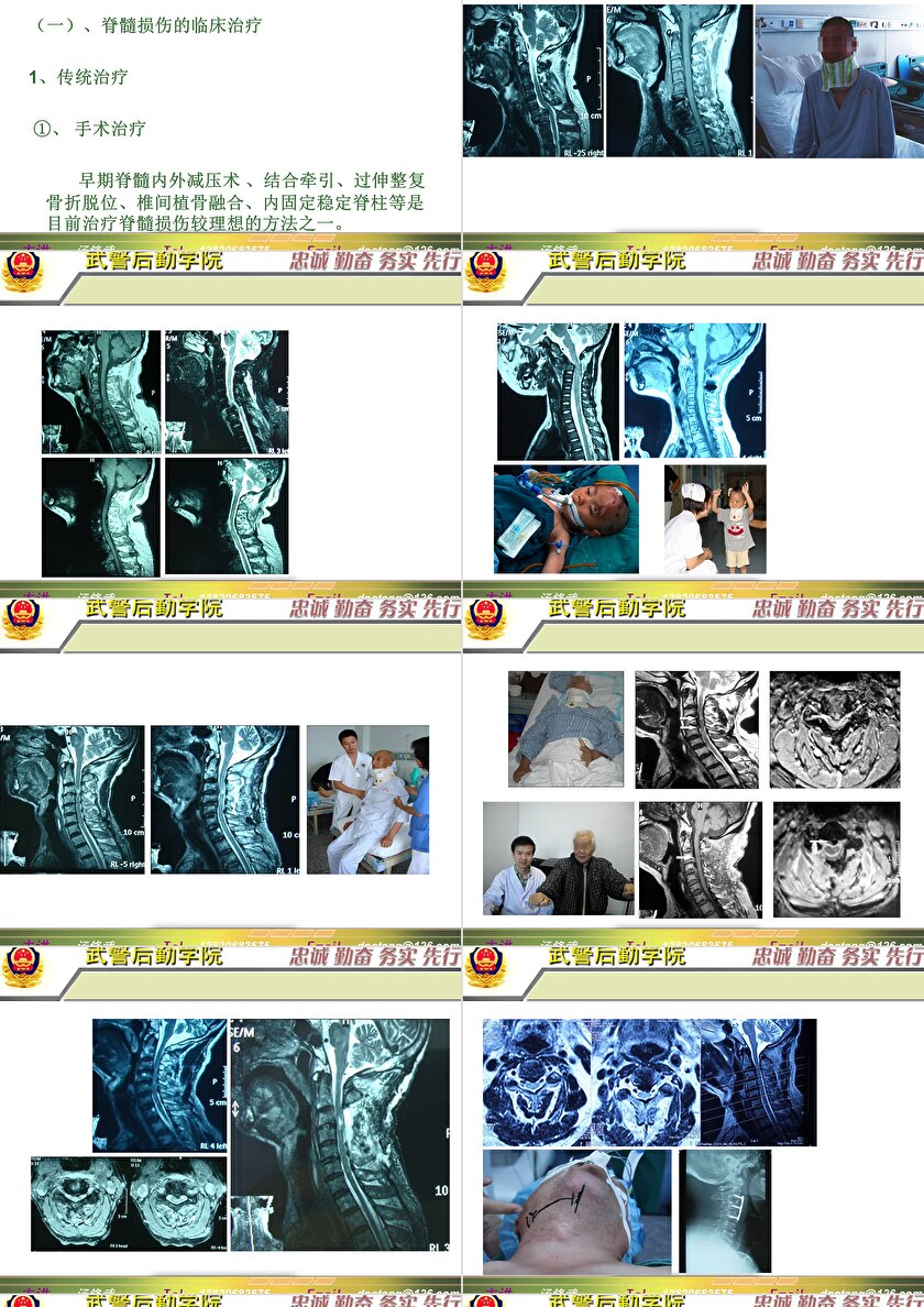 2023年脊髓損傷研究新進(jìn)展，里程碑式的突破與日常奇妙變化