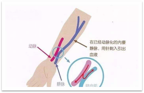 靜脈瘺最新資訊，掌握最前沿的健康信息
